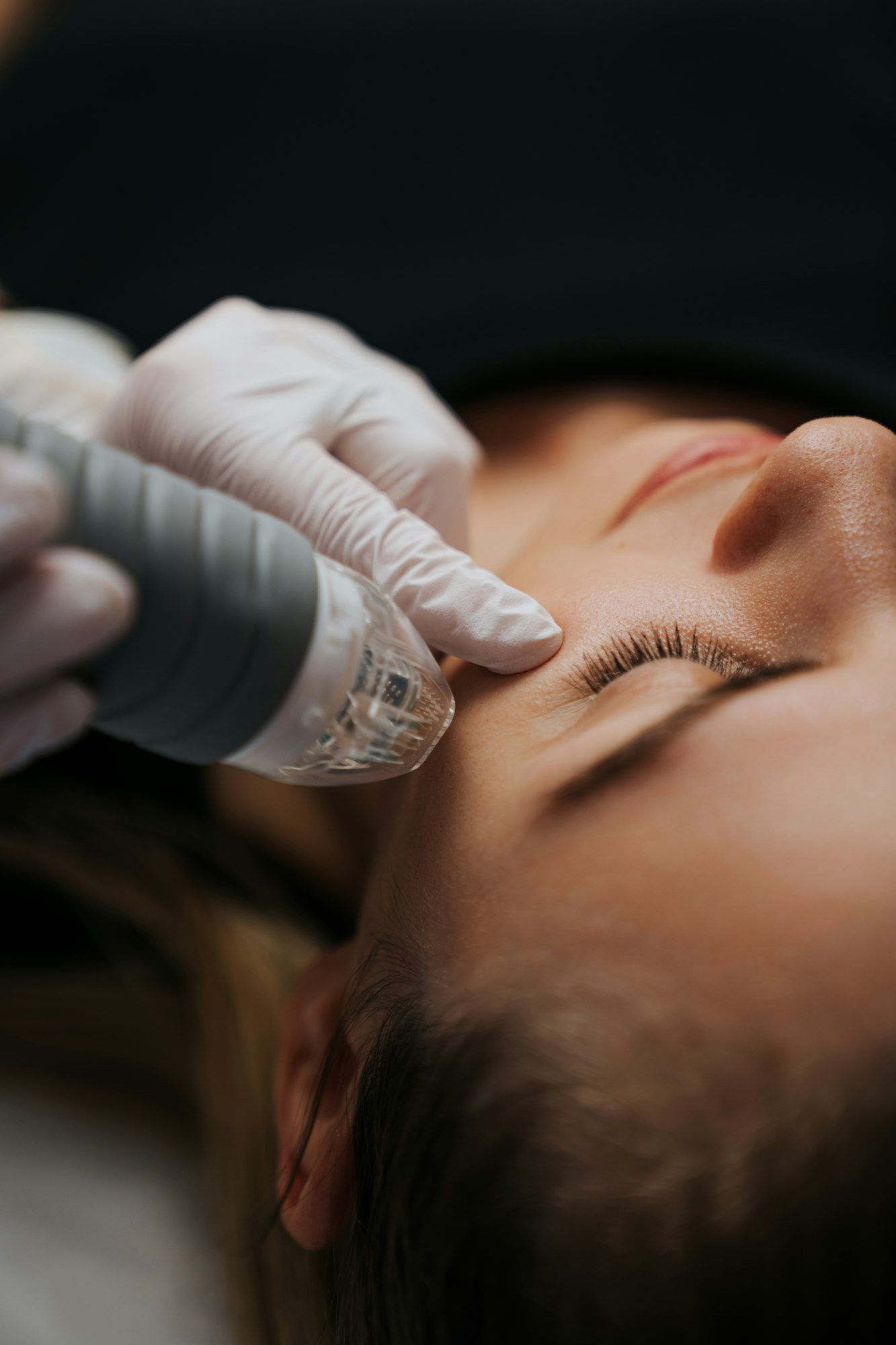 Microneedling Oslo - Nyt AS