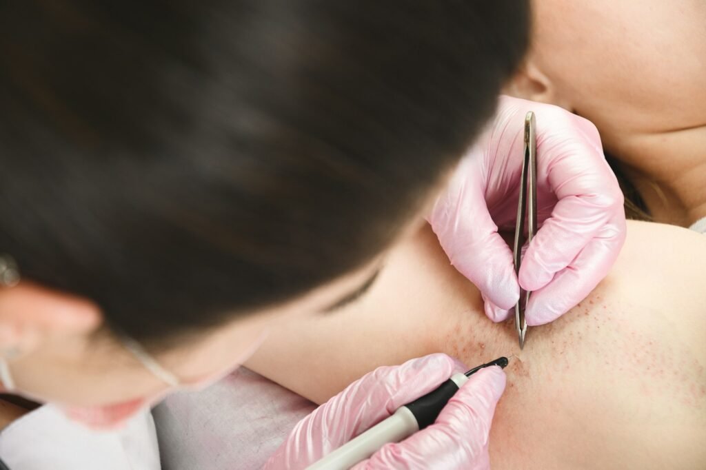 Removal of hair permanently in a woman's armpits using electrolysis.